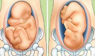 孕妇趴着调整胎位该怎么做好 胎位不正怎么纠正